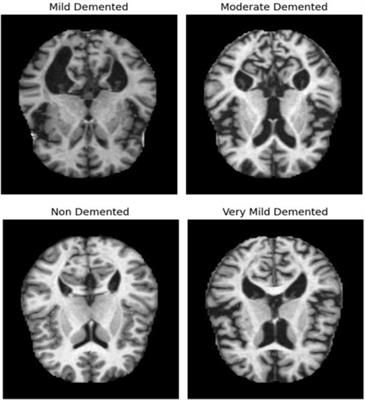 A combinatorial deep learning method for Alzheimer’s disease classification-based merging pretrained networks